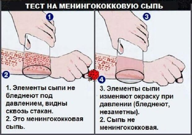 Менингококковая инфекция — Костюковичская центральная районная больница